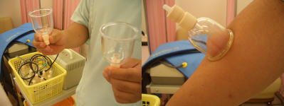 えがお整骨院の吸玉療法(カッピング療法)