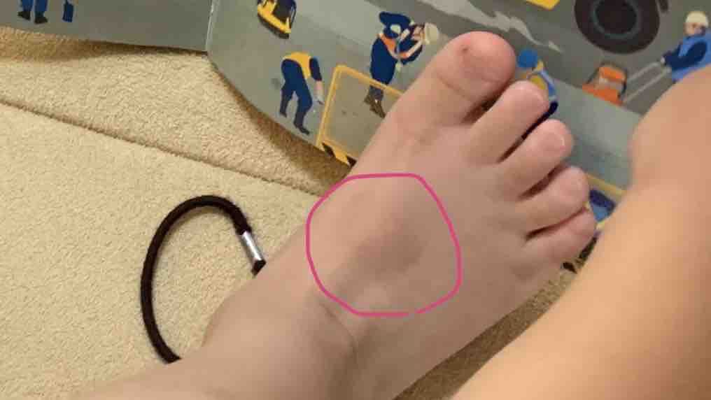 219 甲高幅広の子どもに合う靴 上履きってどれ 足の甲に痣が出現 原因はなに ぴぷめわん家族 年子男女の子育ては大変 時短アイテムでガンガン手抜き