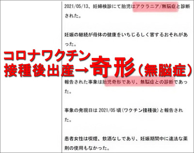 ワクチン死_妊婦接種後出産奇形続発 日本無脳症1