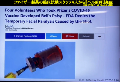 ファイザー 臨床実験で4人が『ベル麻痺』を発症インドのメディア