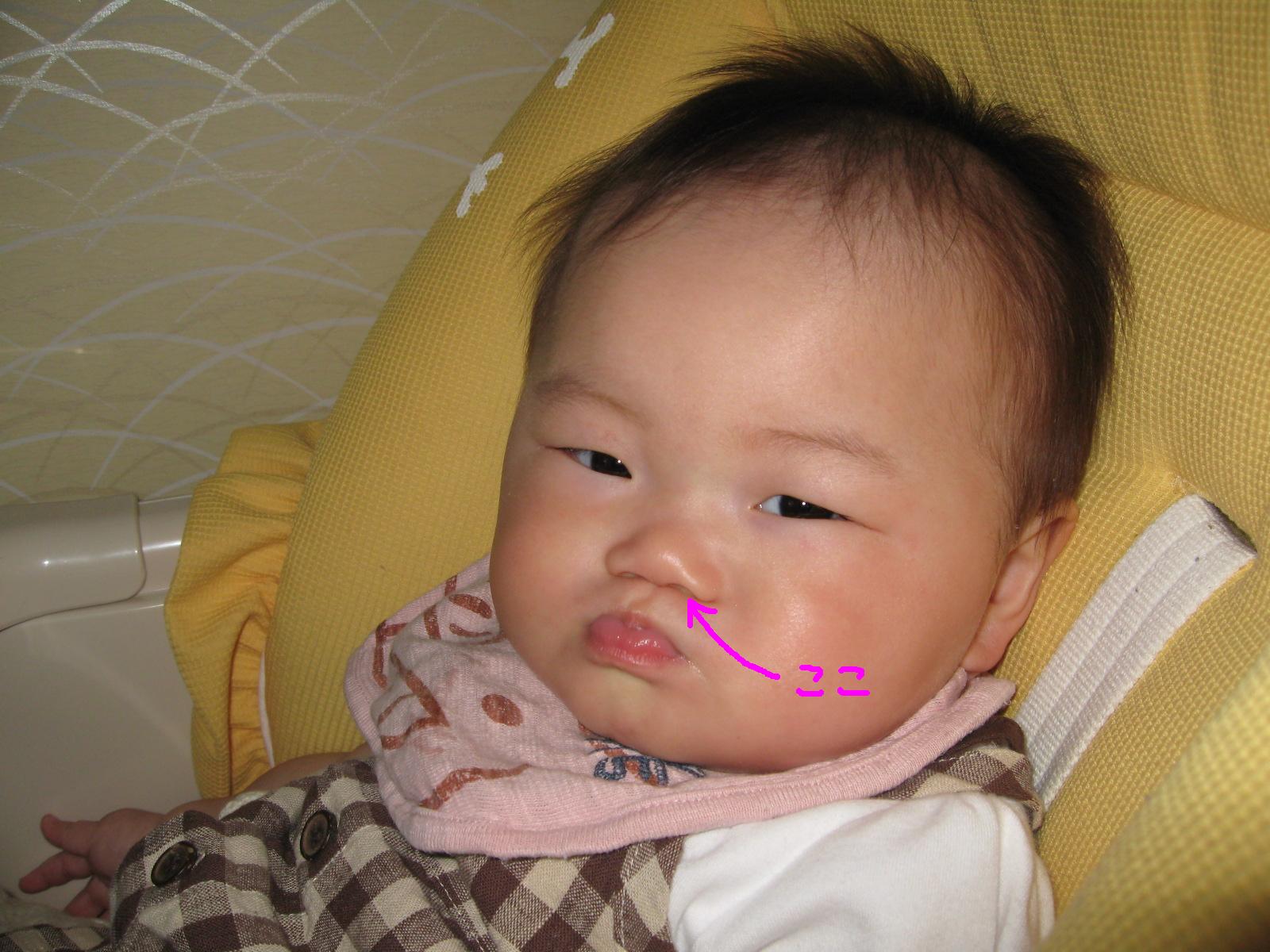 赤ちゃん 鼻の下 214410赤ちゃん 鼻の下 ブツブツ Imagejoshqnb