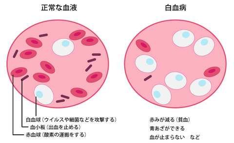 leukemia_top02