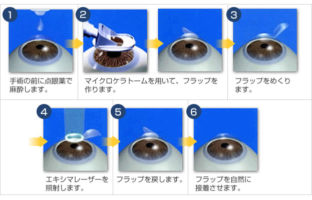 終了 レーシック手術がオワコンになった原因がこちら 画像あり Newsまとめもりー 2chまとめブログ