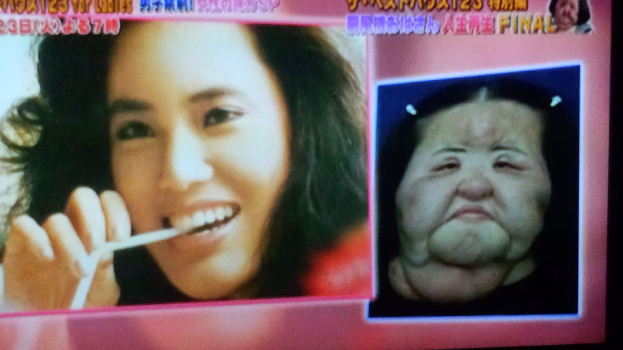 韓国人崩壊 美容整形手術した韓国人の末路がヤバイ 画像あり Newsまとめもりー 2chまとめブログ