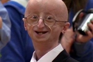 Progeria-the-rare-genetic-disease-300x200