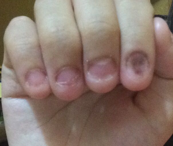 閲覧注意 爪噛む癖を15年間続けた結果 画像あり Newsまとめもりー 2chまとめブログ