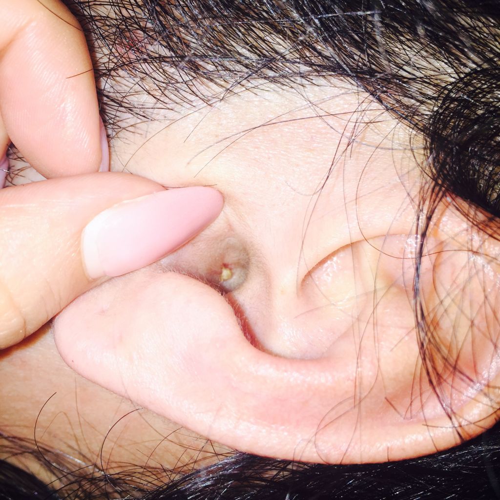 閲覧注意 彼氏に耳かきしてたら恐ろしいものが出てきた 衝撃で眠れない 画像あり Newsまとめもりー 2chまとめブログ 閲覧注意 彼氏に耳かきしてたら恐ろしいものが出てきた 衝撃で眠れない 画像あり Newsまとめもりー 2chまとめブログ