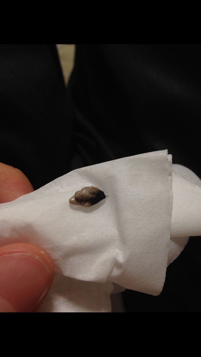 閲覧注意 ワイ ヘソのゴマを取り出した結果 画像あり Newsまとめもりー 2chまとめブログ