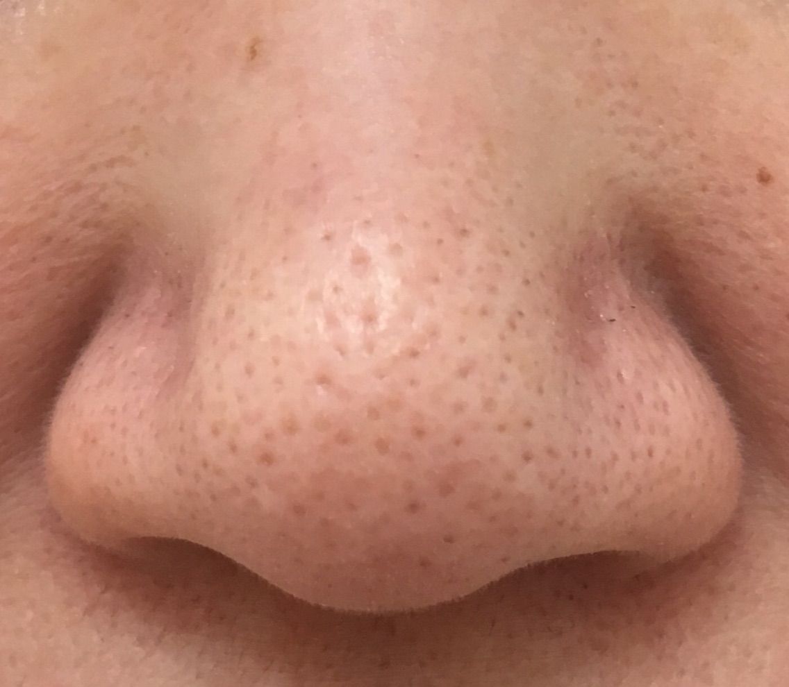 毛穴の開き いちご鼻 あけみ皮フ科クリニックのblog