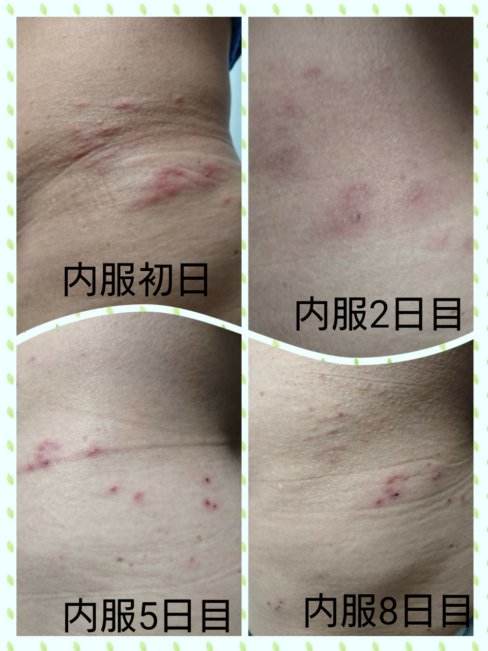 帯状 疱疹 ブログ