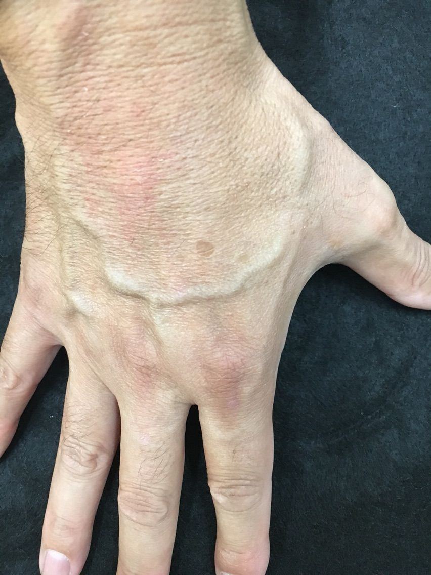 手のシミ 男性編 あけみ皮フ科クリニックのblog