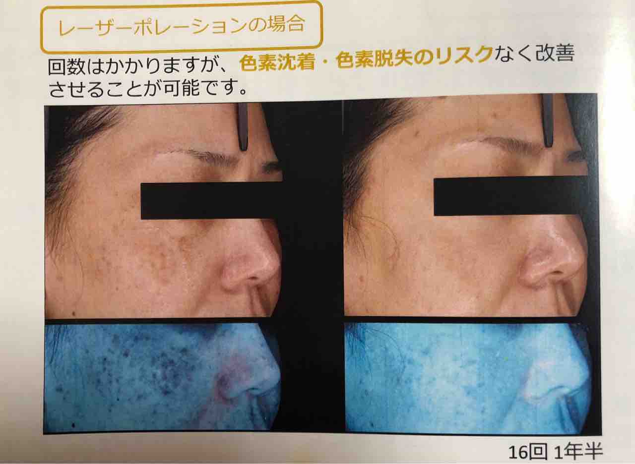 レーザーと美容液導入の相乗効果 レーザーポレーション あけみ皮フ科クリニックのblog レーザーと美容液導入の相乗効果 レーザーポレーション あけみ皮フ科クリニックのblog