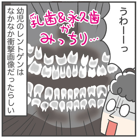 230621_過剰歯02_01