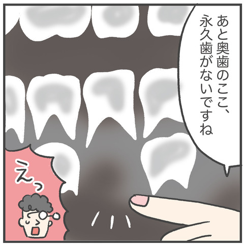 230621_過剰歯02_04