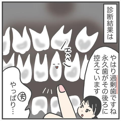 230621_過剰歯02_02