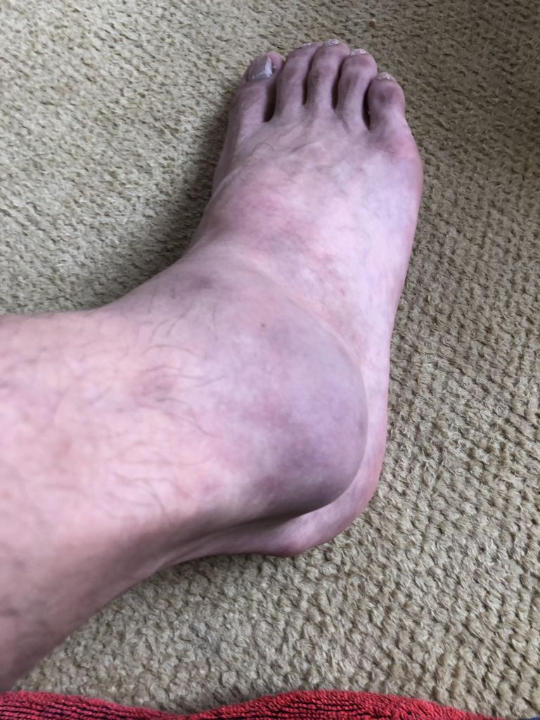 1月6日 バスケでまたも足首捻挫 自由な人生 千古不易 1月6日 バスケでまたも足首捻挫 自由な人生 千古不易