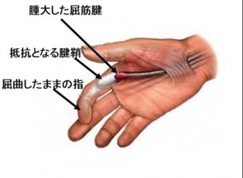 バネ指