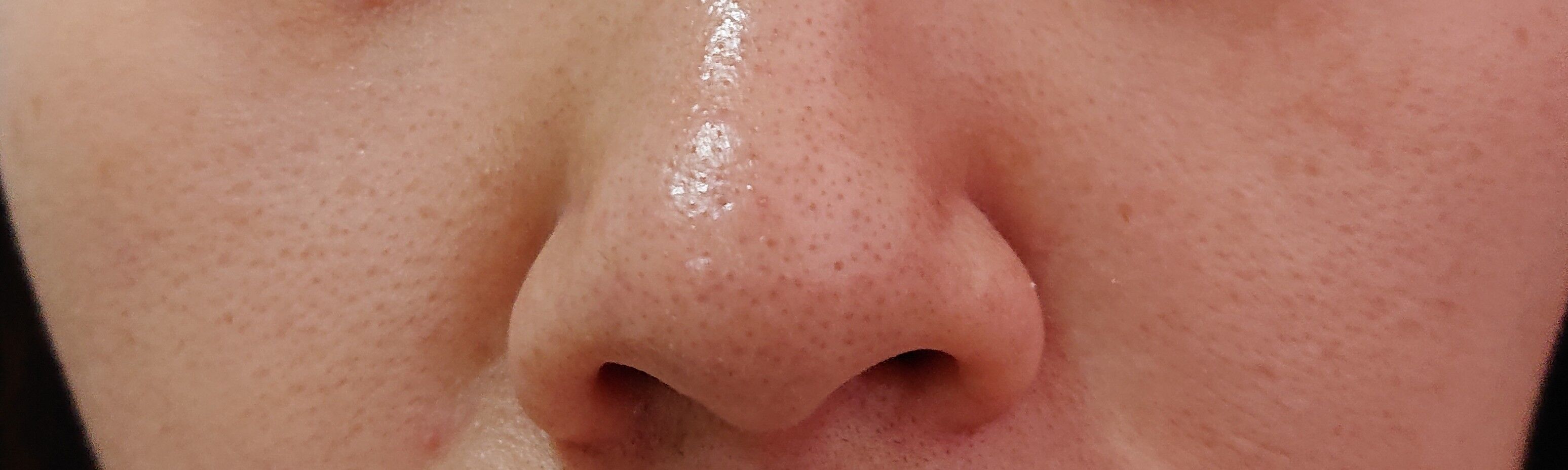 毛穴が汚い 底辺に生きるひよこの日記