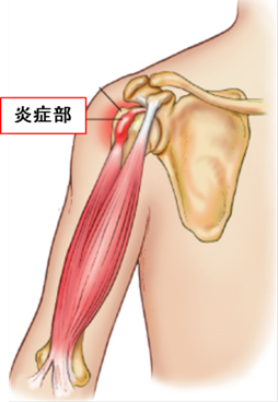 本日の留置鍼治療 あなたの道場 あこう堂 日記 本日の留置鍼治療 あなたの道場 あこう堂 日記