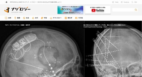 【朗報】うつ病、数分で治ることが判明。脳内に電極を埋め込んで「喜び回路」を刺激