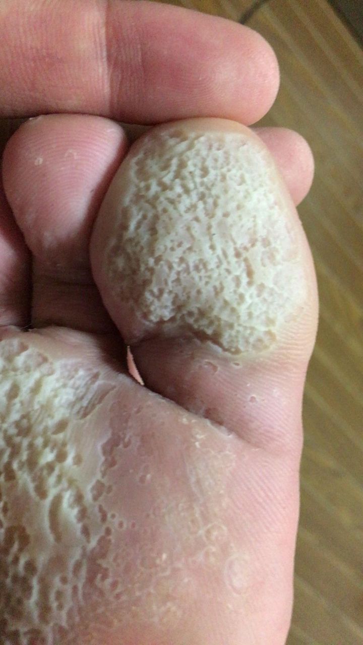 悲報 俺の足裏がヤバい 閲覧注意 ひきこもり速報