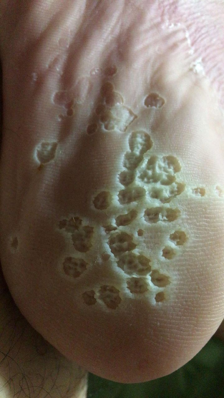 悲報 俺の足裏がヤバい 閲覧注意 ひきこもり速報