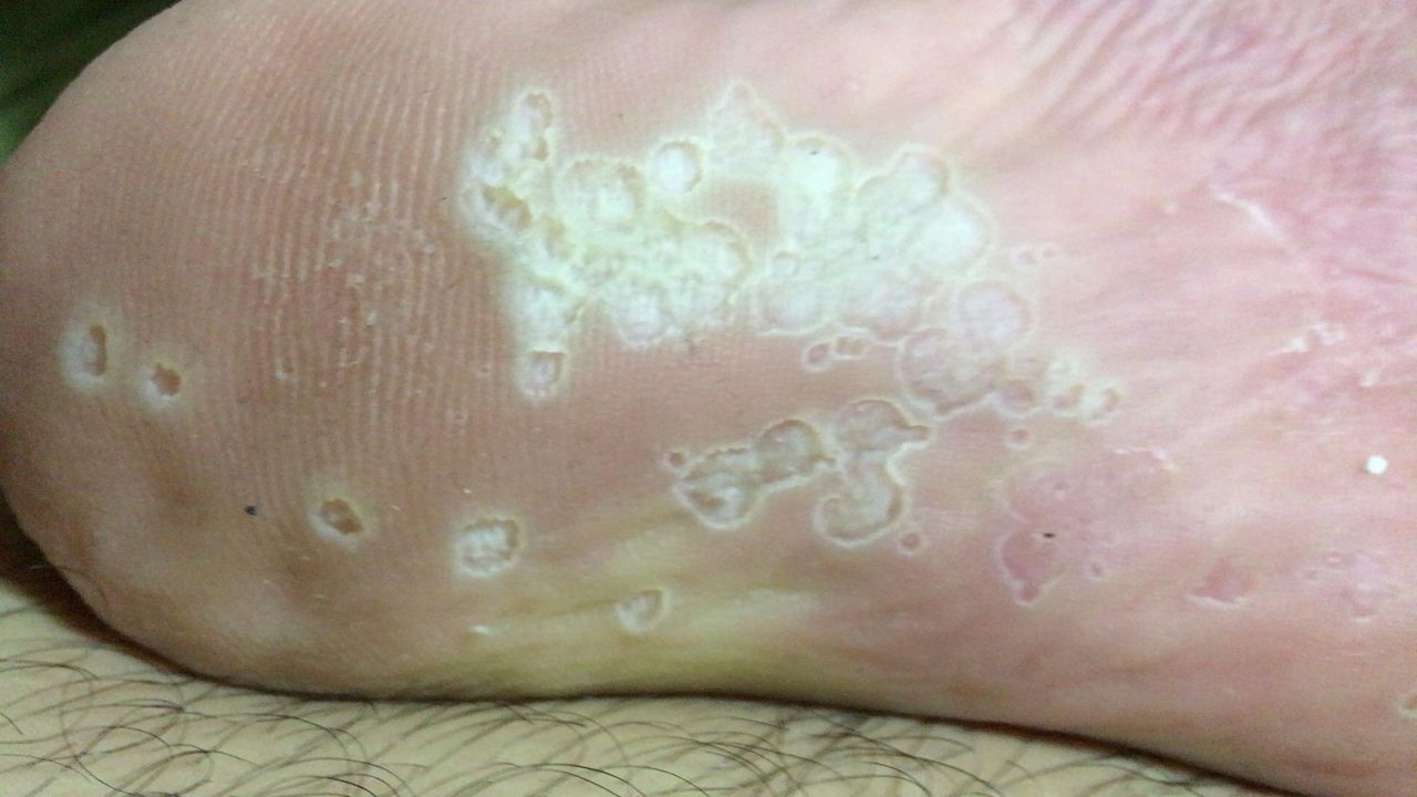 悲報 俺の足裏がヤバい 閲覧注意 ひきこもり速報