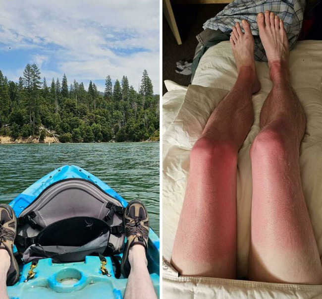 funny-sunburn-tan-lines-fails-4-6694ccb2767bf__700