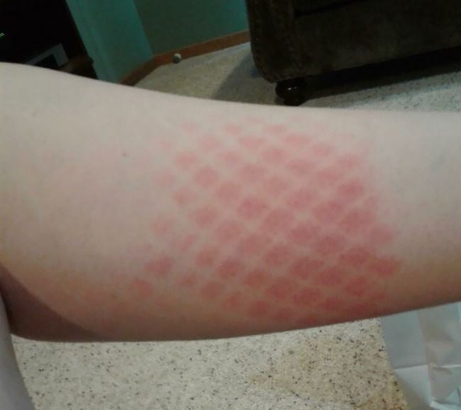funny-sunburn-fails-25-62de93e124185__700
