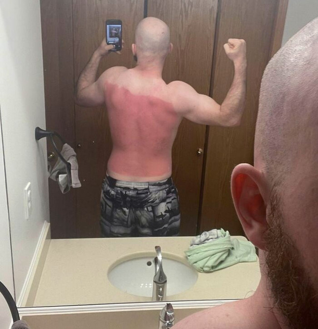 funny-sunburn-fails-27-62de79d34f374__700