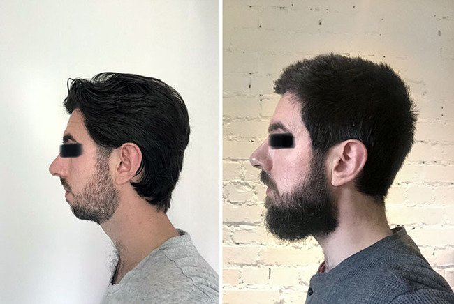 before-after-beard-growing-pics-60-64520f64d4c2f__700