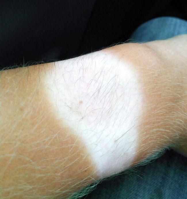 funny-sunburn-tan-lines-fails-3-6690c0077b0c3__700