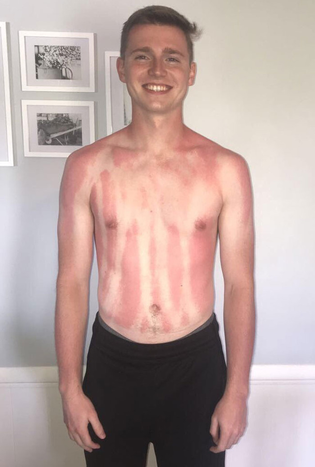 funny-sunburn-fails-13-62de89533e83f__700