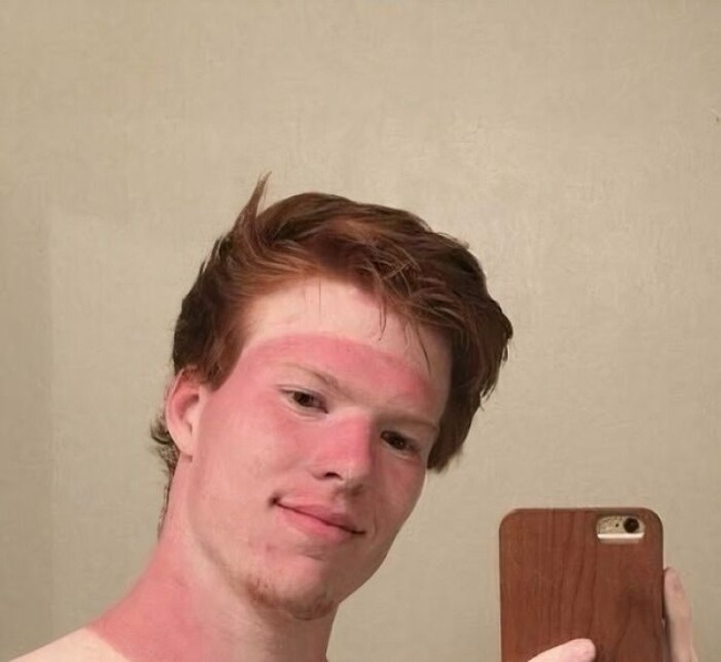 6698d44107797_funny-sunburn-tan-lines-fails