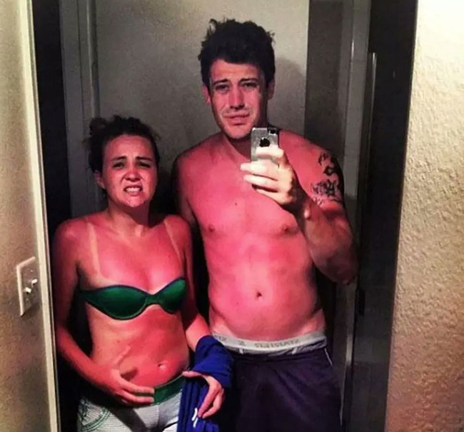funny-sunburn-fails-17-62de900f7d260__700 (1)