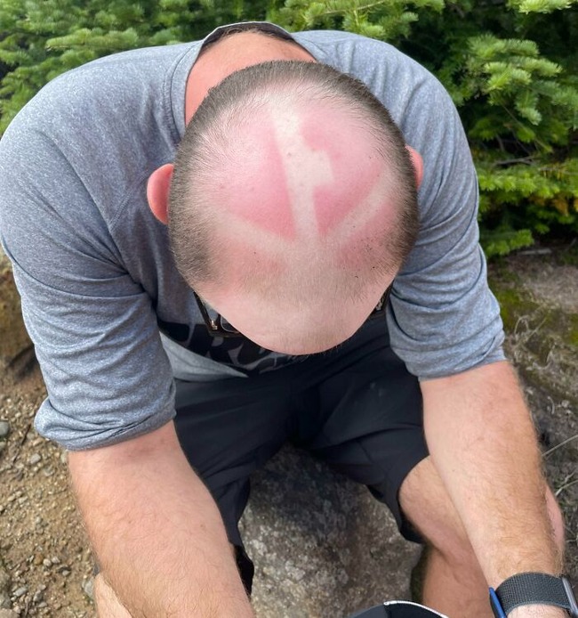 62deb1c89d661_funny-sunburn-fails