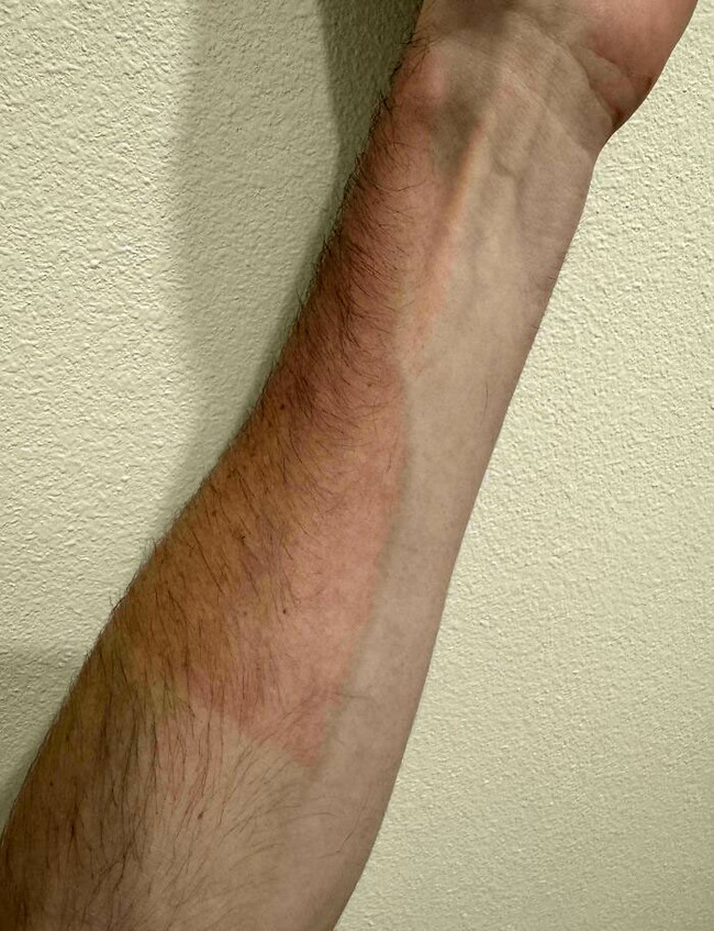 funny-sunburn-tan-lines-fails-13-66951fa55e56d__700