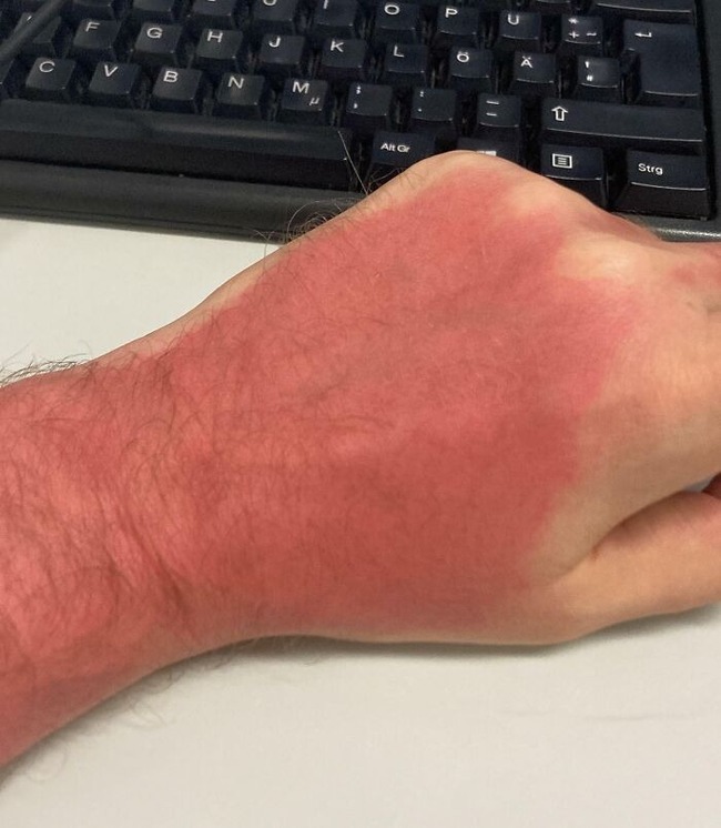 6694cd5f4ab0e_funny-sunburn-tan