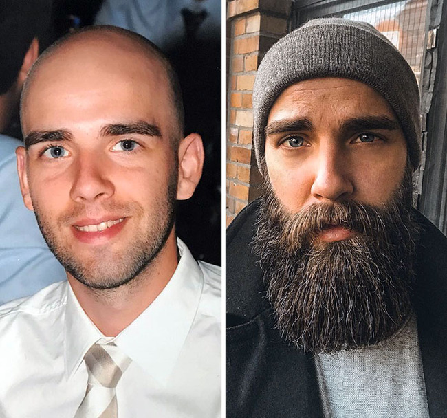 before-after-beard-growing-pics-21-6451103009b64__700