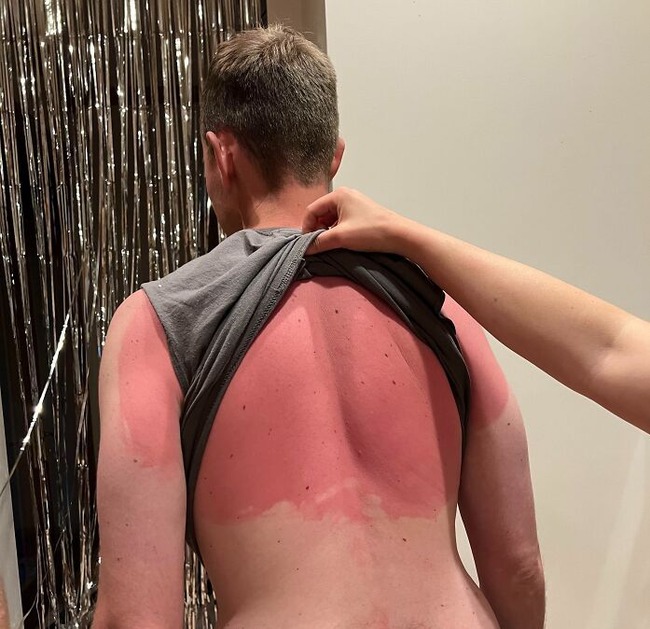 6694cd6ea867a_funny-sunburn-tan-lines-fails