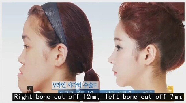 double jaw v line surgery korea