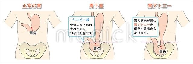 胃下垂ってどうしたら治るんだよおおおおお あれるげん速報 胃下垂ってどうしたら治るんだよおおおおお あれるげん速報
