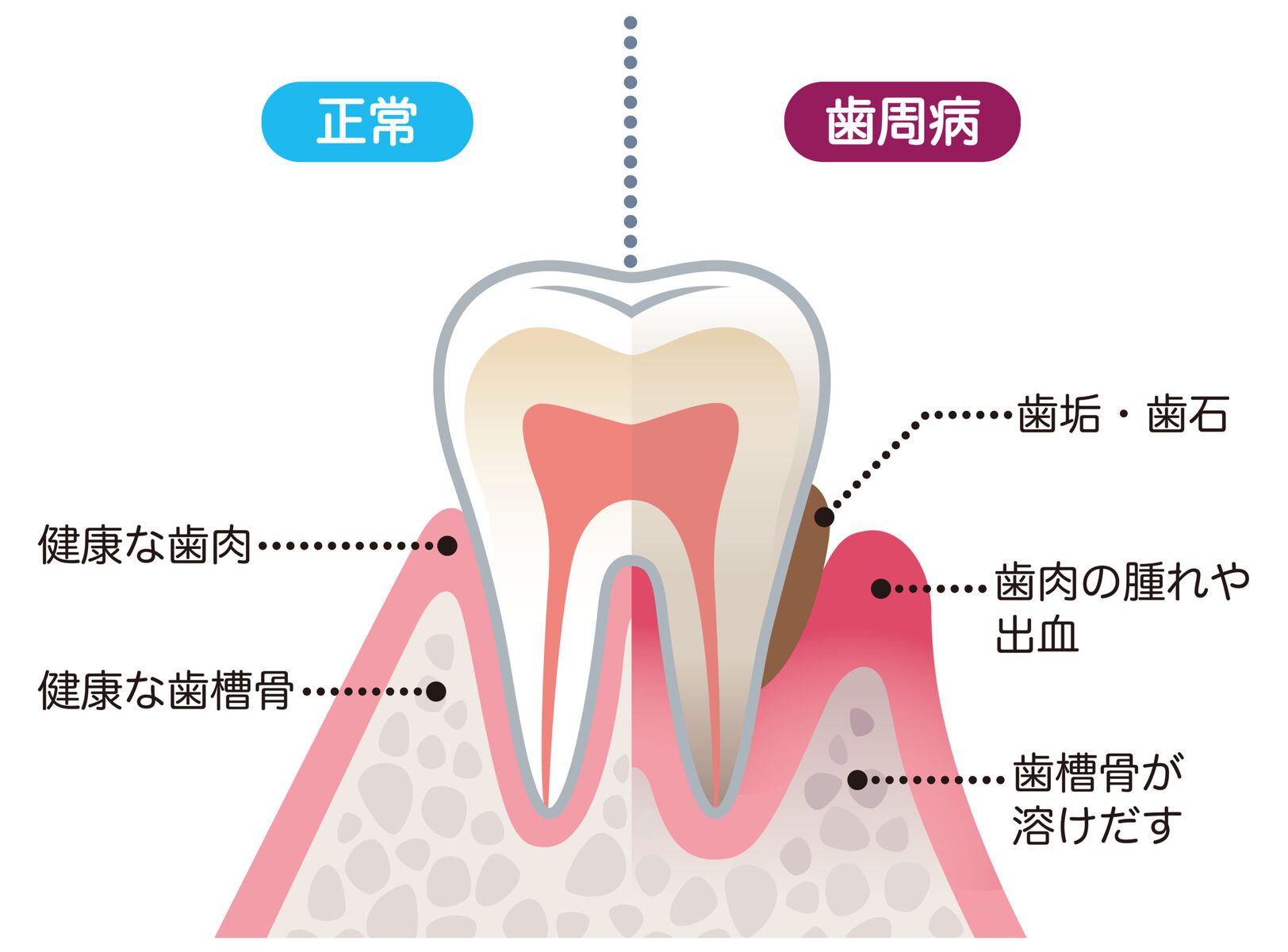 歯周病が認知症につながる仕組みを解明 僕のまとめ 気になる情報まとめサイト