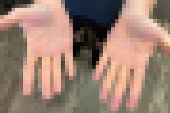 【画像】チーズを1日4kg食べていたアメリカ人、とんでもないことになる