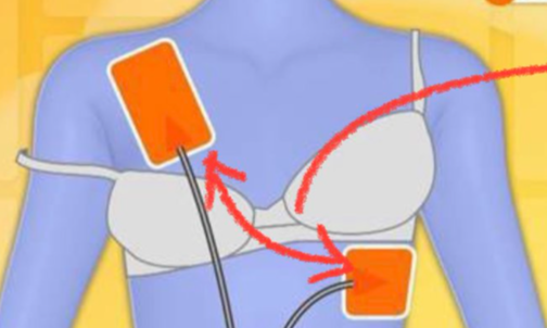 【画像】識者「えーっと、ブラを外さなくても女性へのAEDはできるかなと思います」　