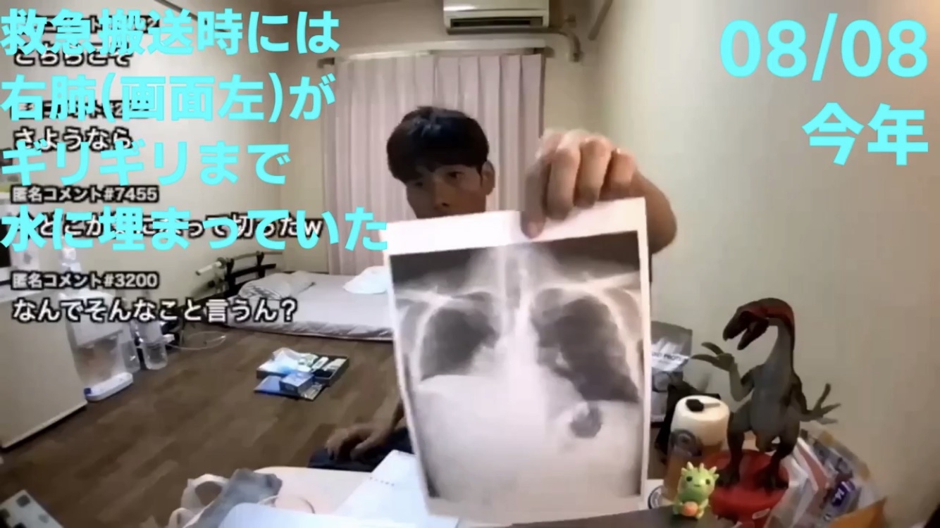 溺死 肺炎 足首 肺水腫 肺に関連した画像-02