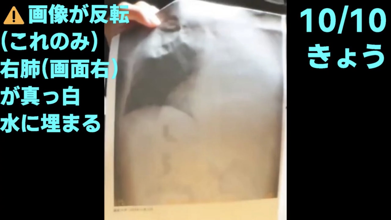 溺死 肺炎 足首 肺水腫 肺に関連した画像-03