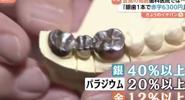 【悲報】銀価格が３年で4倍に高騰　歯科医院「赤字になる」銀歯を作れば作るほど苦境に