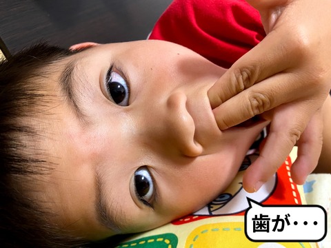 どんどん無残になっていく、前歯!!