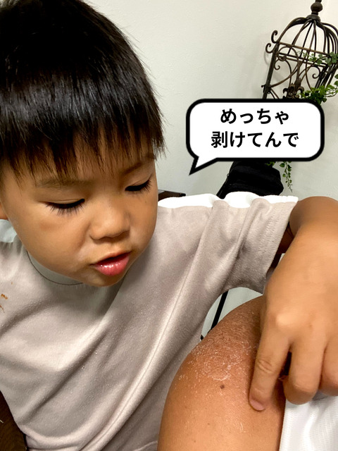 日焼けした皮をキレイに剥く方法！